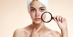 combate el acne con cosmetica natural